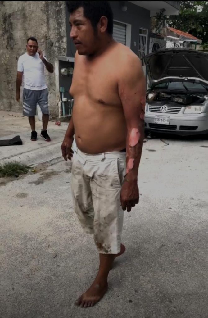 Termina mecánico con quemaduras de tercer grado en Playa del Carmen